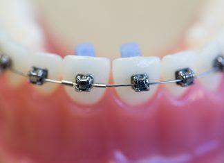 Мифы о брекетах
