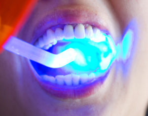 Светоотверждаемая пломба: плюсы и минусы