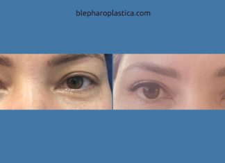 Какие результаты можно получить с помощью пластики век?