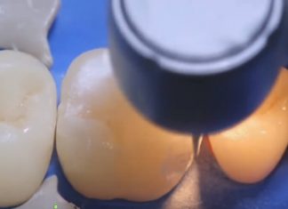 Этапы пломбирования зубов