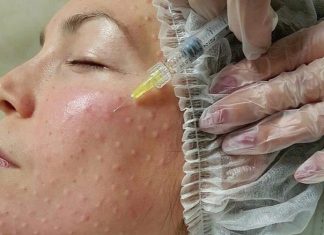 Что представляет собой биоревитализация лица?