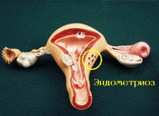Методы лечения эндометриоза