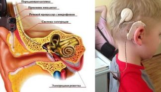 Для чего устанавливают кохлеарный имплантат?