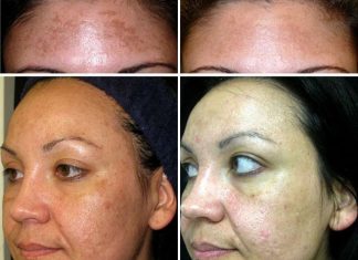 Омолаживание диодным лазером: возможность усовершенствовать кожу лица и шеи