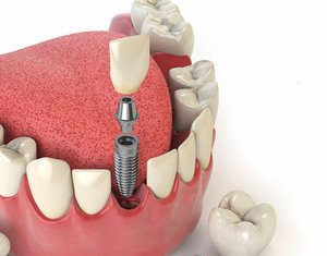Технология установки имплантов зубов