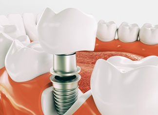 Этапы протезирования зубов в стоматологической клинике