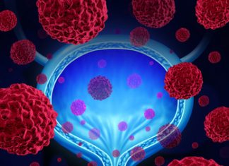 Лечение рака мочевого пузыря