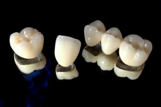 Металлокерамика: востребованный и бюджетный вариант, используемый в современной стоматологии