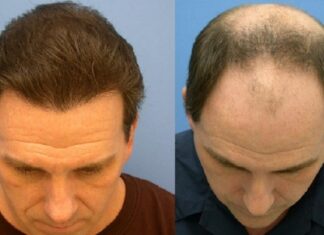 Современные способы пересадки волос