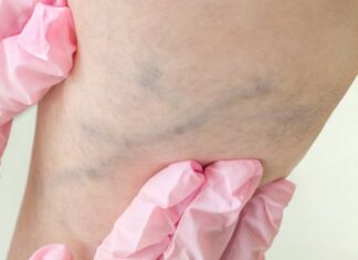 Лечение варикозной болезни лазером