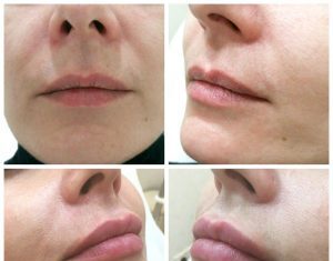 На что обратить внимание при выборе филлера?