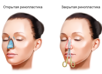 Этапы пластической операции ринопластика