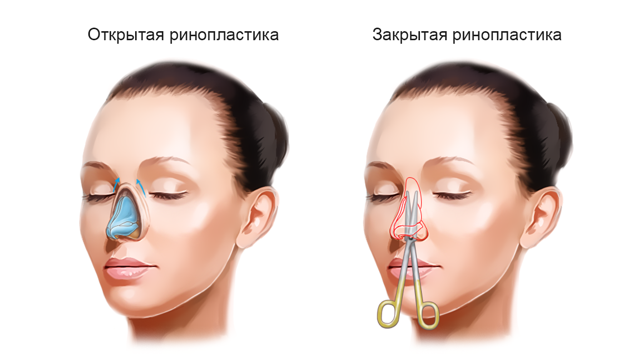 Операция простая. Закрытая ринопластика операция. Ринопластика носа открытая и закрытая. Аугментационная ринопластика носа. Закрытая ринопластика носа.