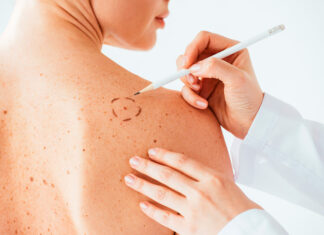 Меланома: причины появления