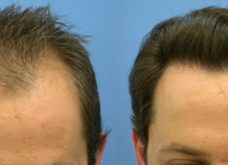 Метод FUE бесшовный метод пересадки волос