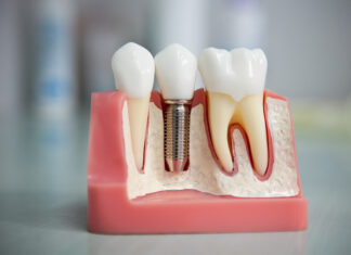 Современные методы протезирования зубов