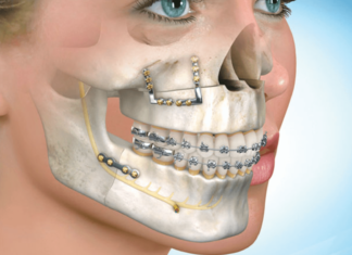 Современные методы исправления прикуса