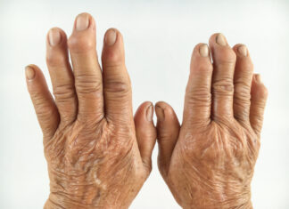 Методы лечения артрита