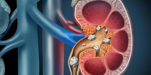 
Уролог Малхасян назвал опасные признаки камня в почках                
