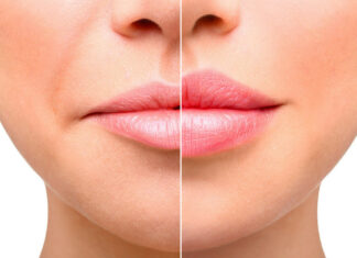 Как убрать носогубные складки?