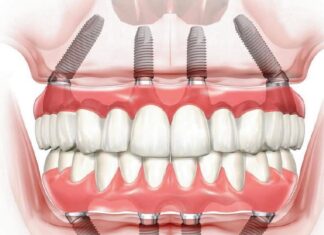 Имплантация all-on-4: новая технология для пациентов с беззубой челюстью