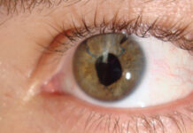 Причины отслоения сетчатки глаза