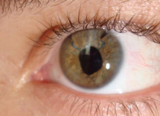 Причины отслоения сетчатки глаза