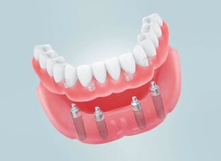 Отличительные особенности условно-съемного протезирования