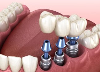 Что представляет собой аналог импланта в стоматологии?